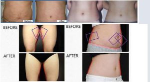 Cavitation+ RF Body Slimming System5