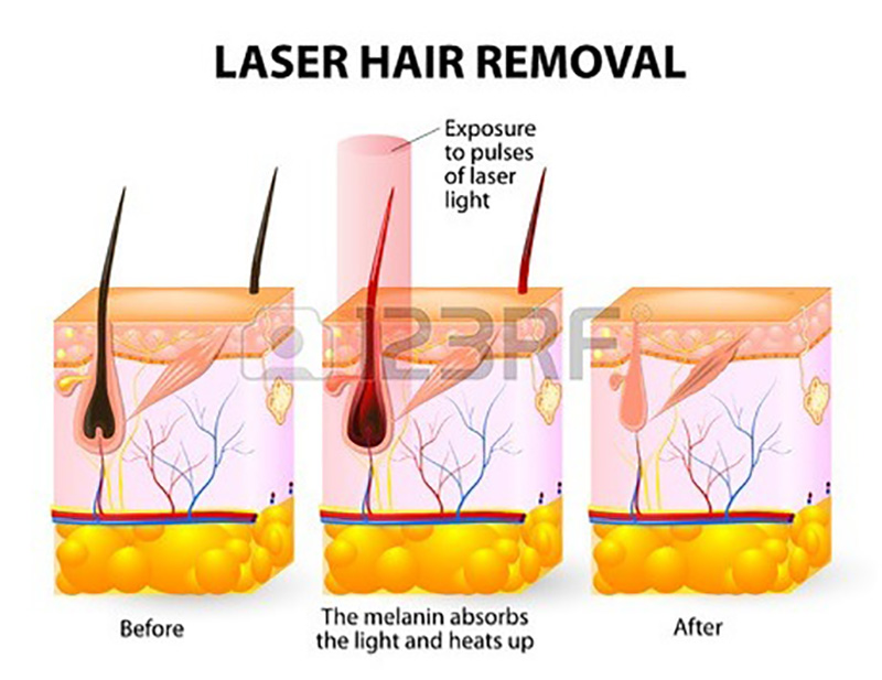 DIODE LASER SYSTEM FOR HAIR REMOVAL (2)