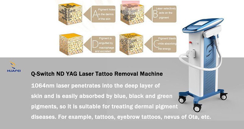 Q-Switched NdYAG Laser System1